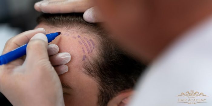 Trapianto Di Capelli