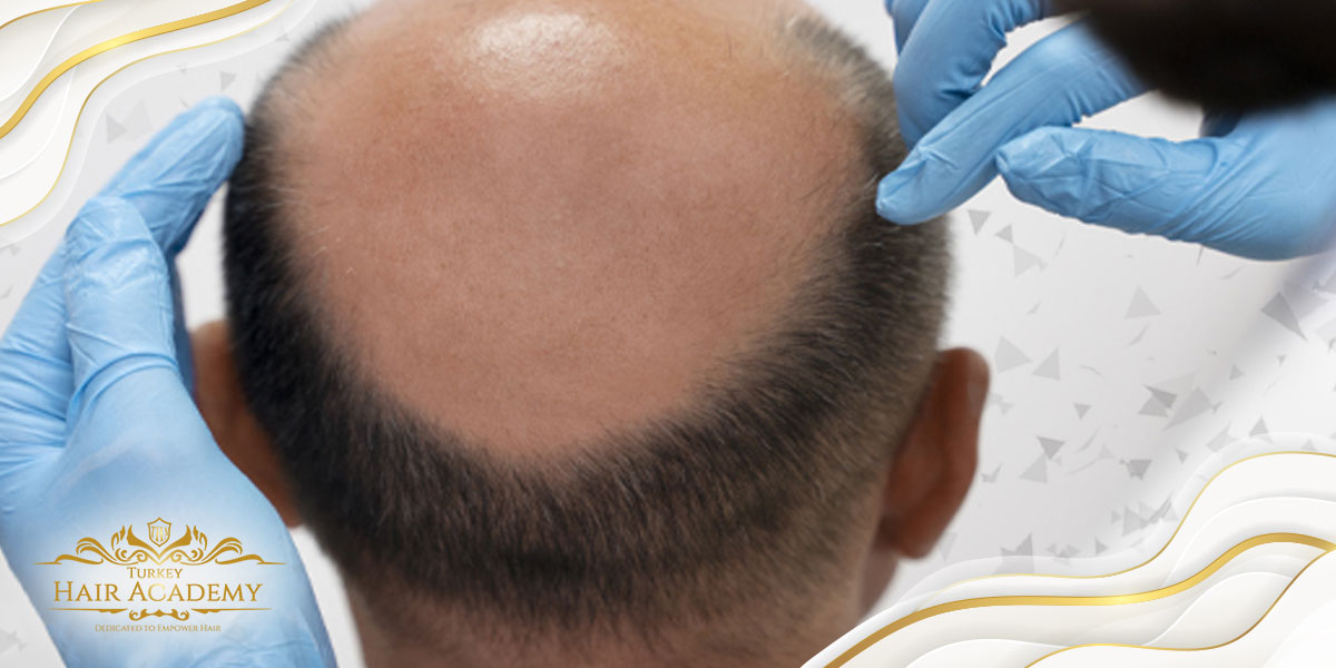 Important things you should know before planning hair transplant   Lifestyle NewsThe Indian Express