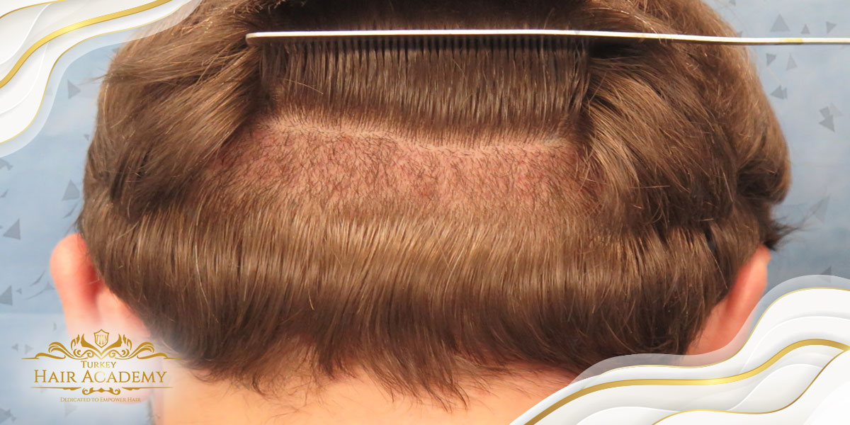 ¿De qué áreas se toman las raíces en el trasplante de cabello?  ¿Qué tan eficiente es?