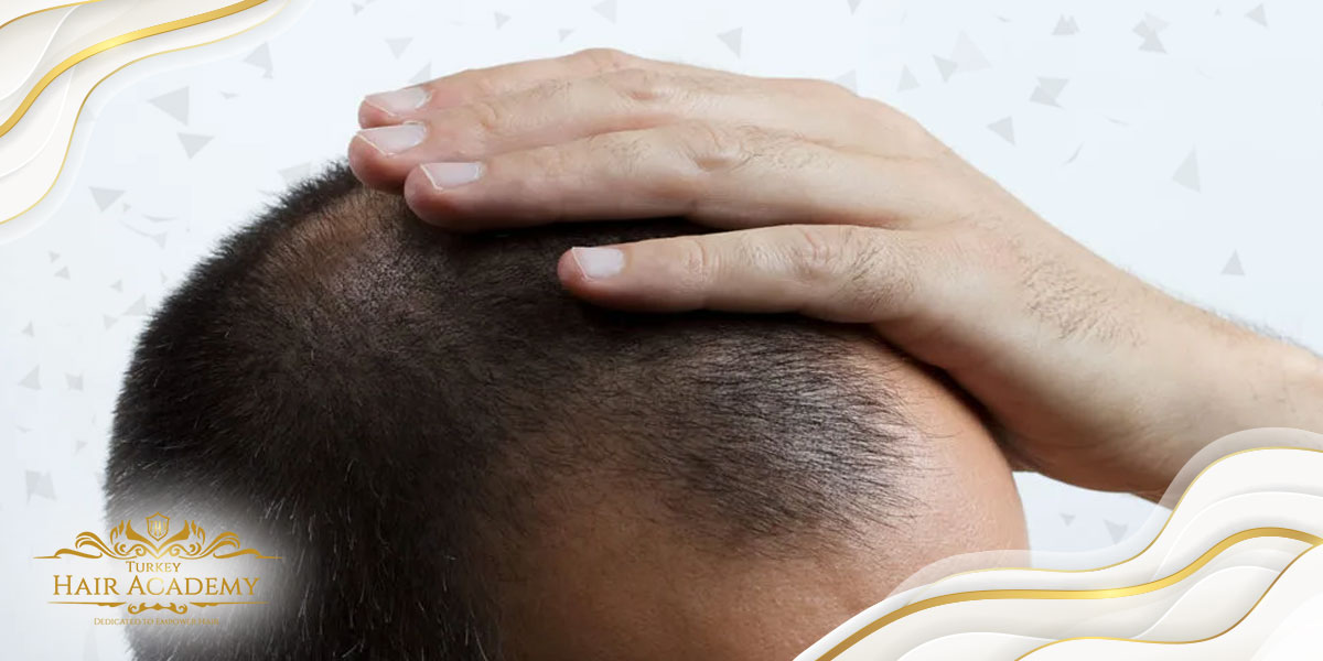 ¿Es correcto el trasplante de cabello mientras continúa la caída del cabello?