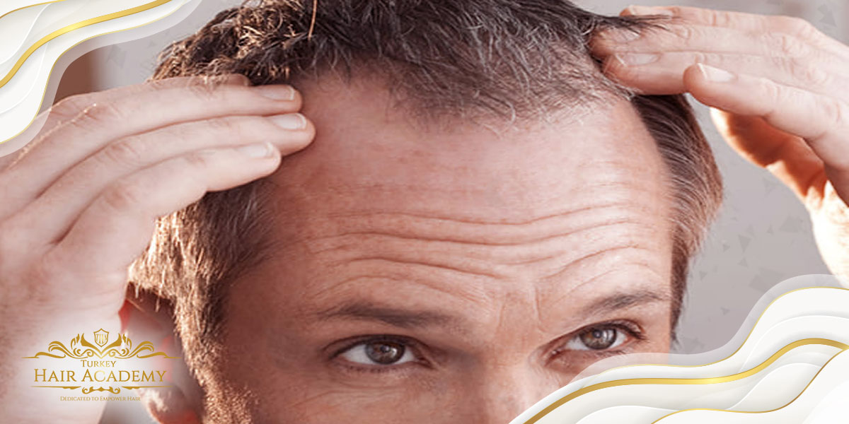 Est-il Possible de Perdre les Cheveux Préexistants Après une Greffe de Cheveux ?