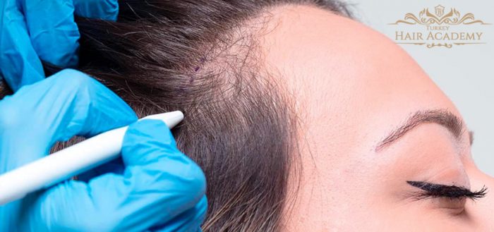Hair Transplant for Women