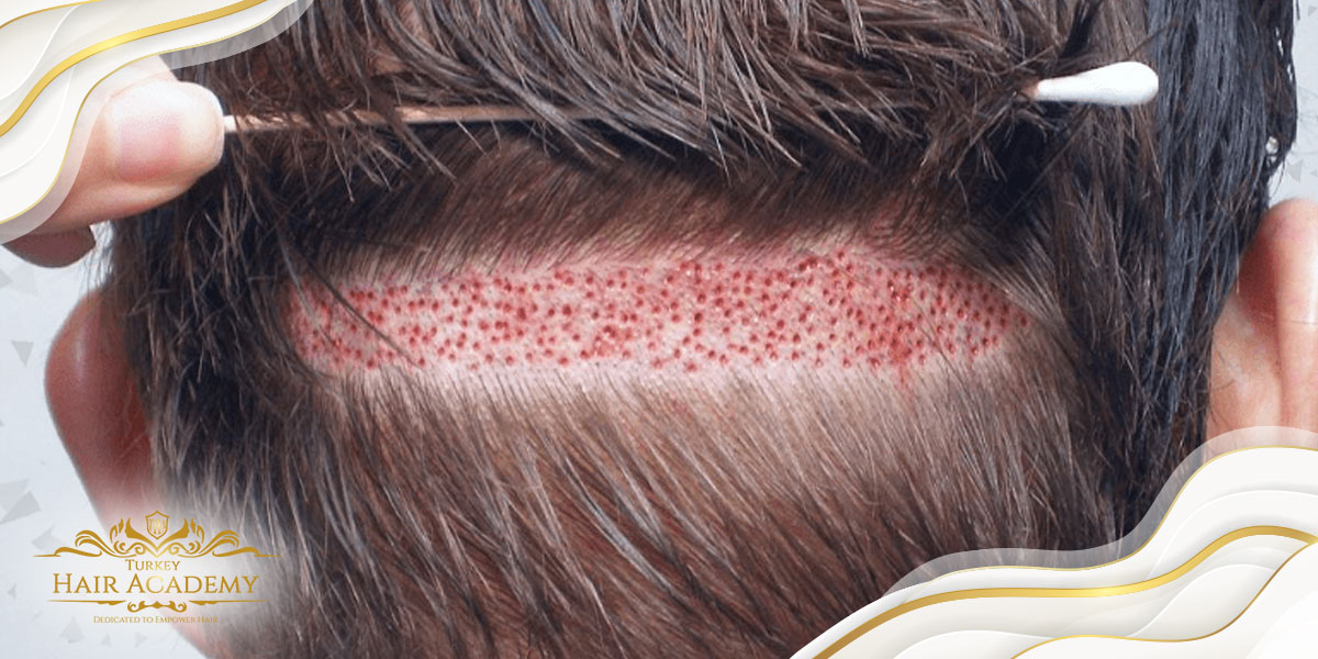Quelle méthode de greffe de cheveux me convient le mieux ?
