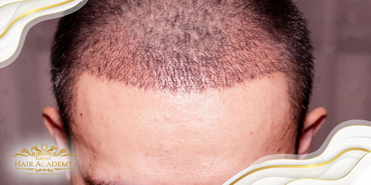 Qu'est-ce qui cause l'acné après une greffe de cheveux?