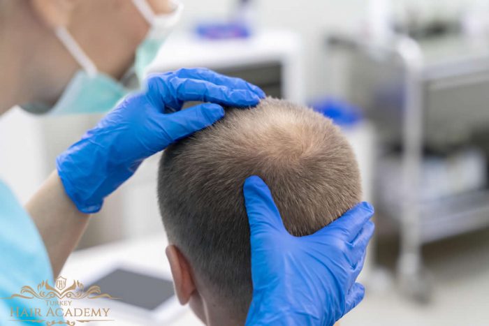 Unshaven Hair Transplant