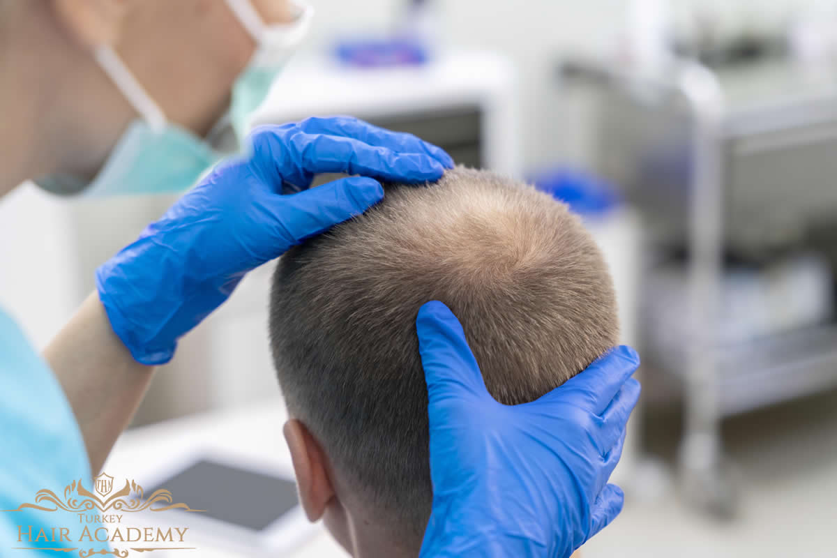 unshaven hair transplant