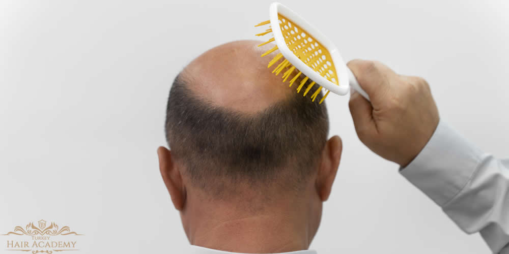 Caduta dei capelli e trapianto di capelli con la tecnica DHI