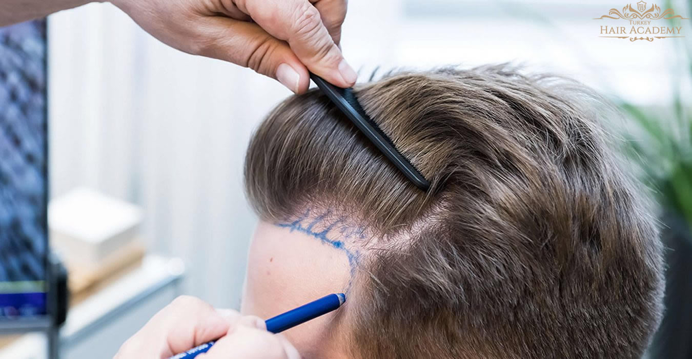 hair transplant with dhi technique