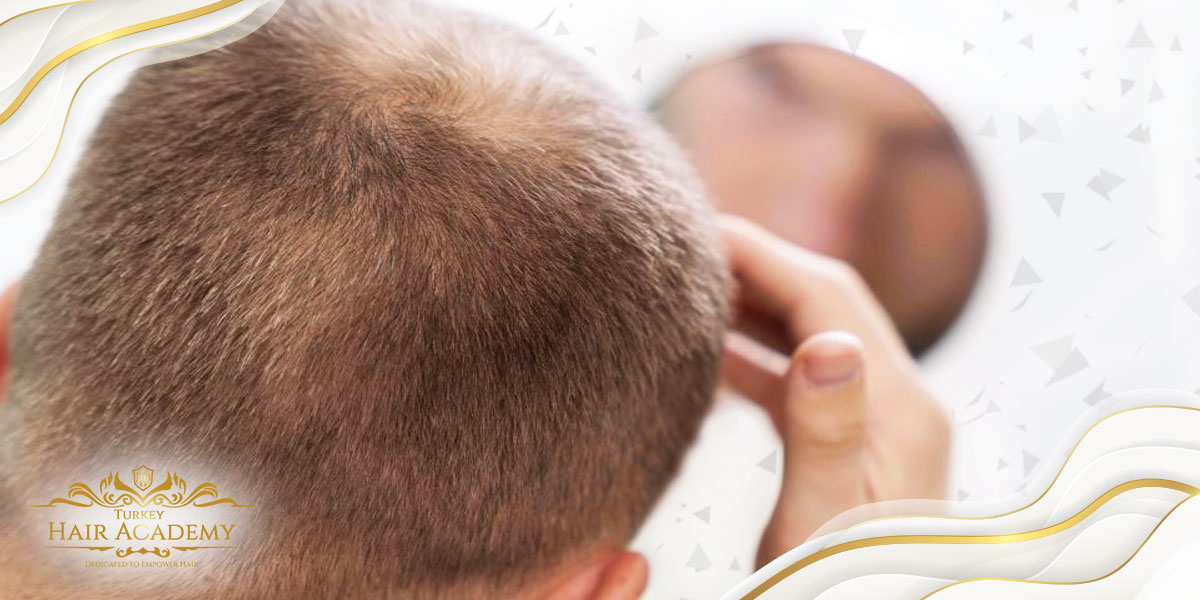 Il Trapianto di Capelli è Permanente?
