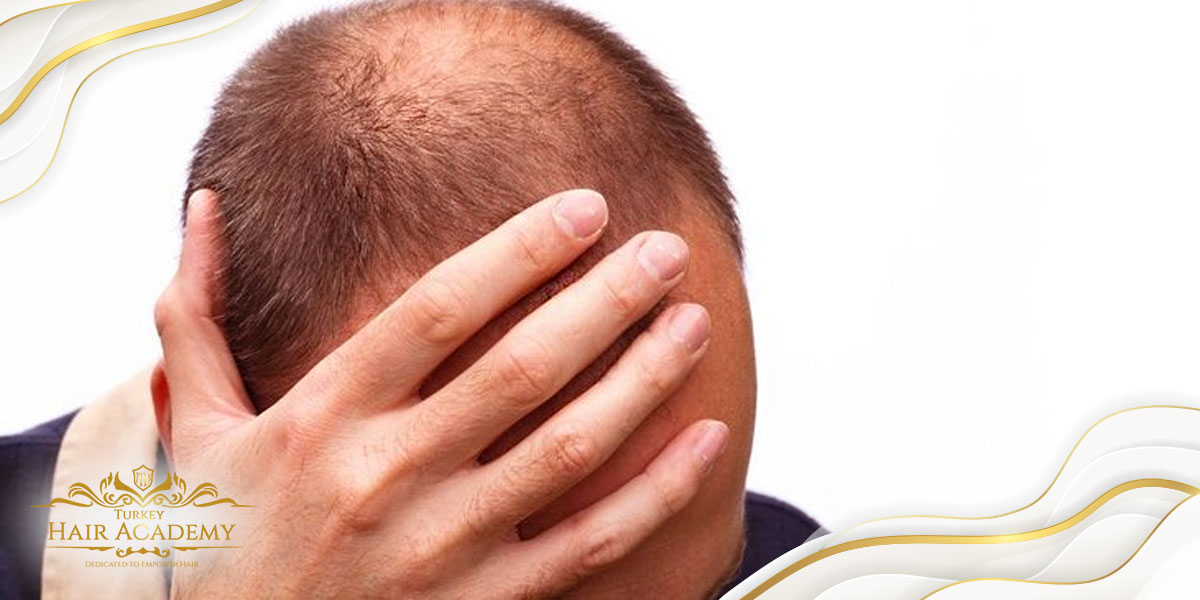 The Psychological Effects of Hair Loss