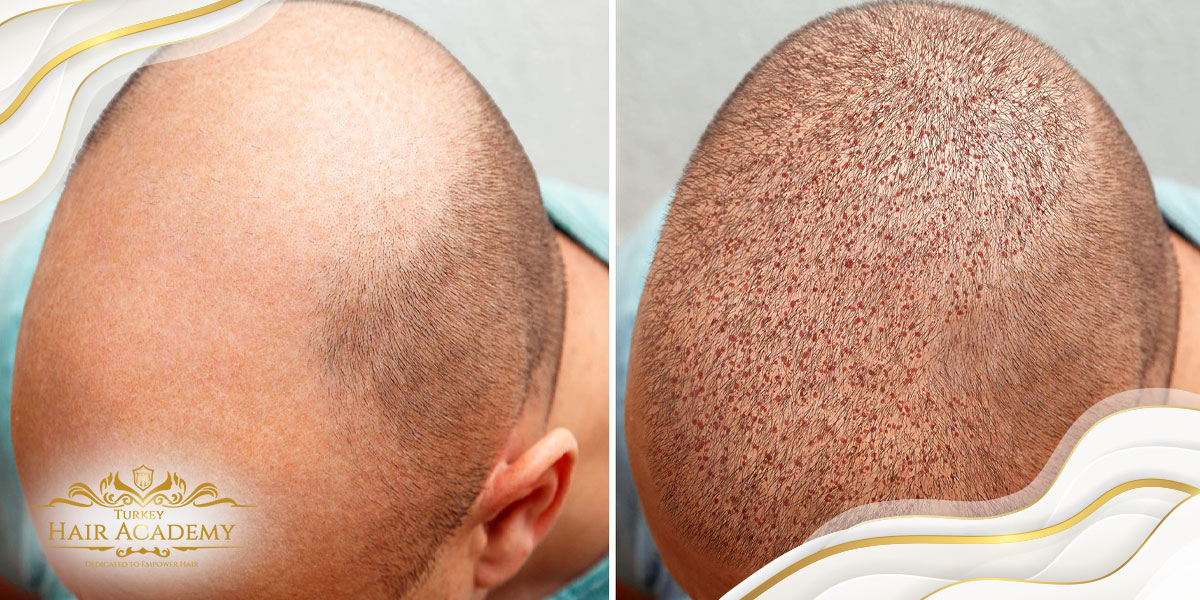 What is the process after hair transplantation?