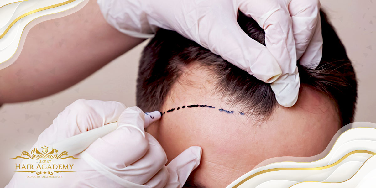 Главные 5 вопросов которые интересуют пациентов решающих сделать трансплантацию волос