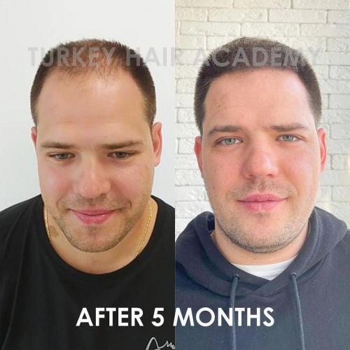 Hair Transplant in Turkey