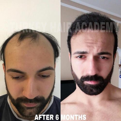 Hair Transplant in Turkey