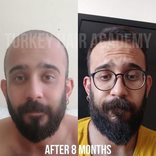 Hair Transplant in Turkey