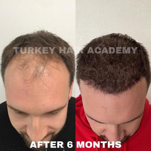 Hair Transplant in Turkey