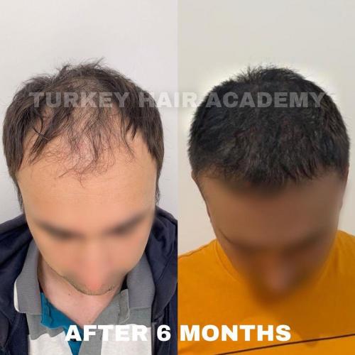 Hair Transplant in Turkey