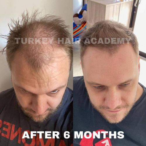 Hair Transplant in Turkey