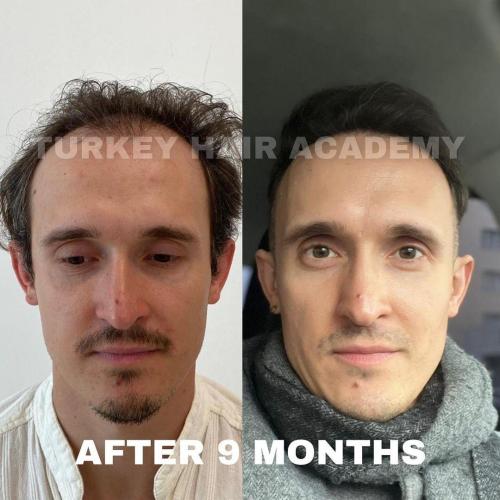 Hair Transplant in Turkey