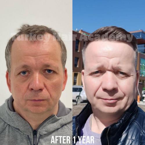 Hair Transplant in Turkey