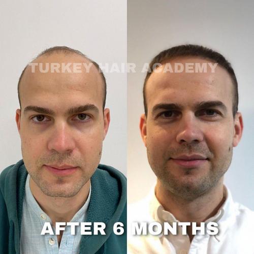 Hair Transplant in Turkey