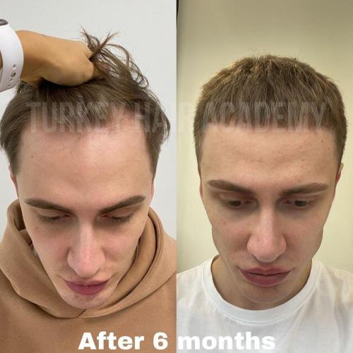 Hair Transplant in Turkey