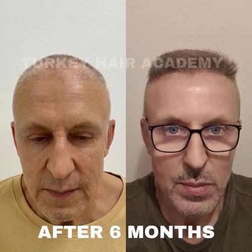 Hair Transplant in Turkey