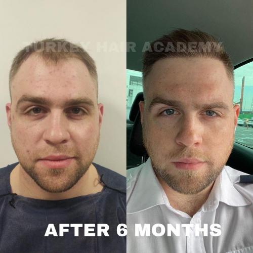 Hair Transplant in Turkey