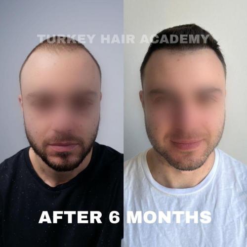 Hair Transplant in Turkey