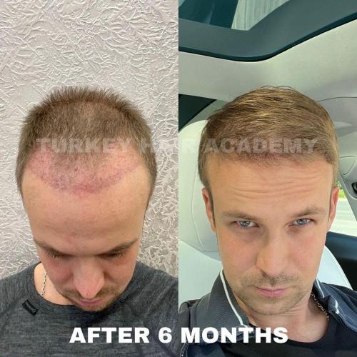 Hair Transplant in Turkey