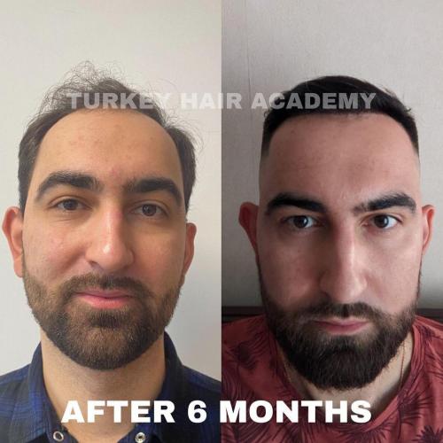 Hair Transplant in Turkey